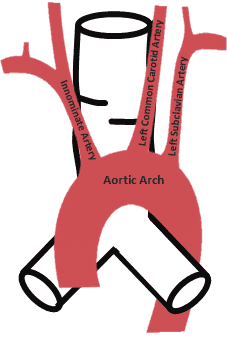 Innominate artery usually crosses the trachea at the 9th cartilage ring